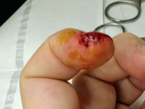 Five Stitches in Left Index Finger